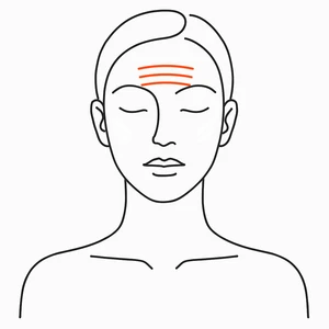 Brow and forehead, XERF radiofrequency skin tightening London