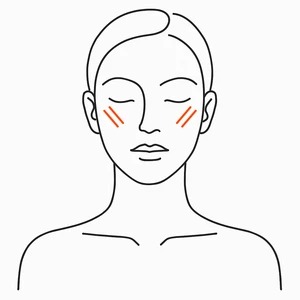 Cheeks, XERF radiofrequency skin tightening London