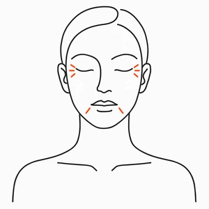 Fine lines, XERF radiofrequency skin tightening London